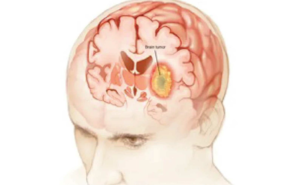 Head Cancer Head and Neck Reconstruction Surgery