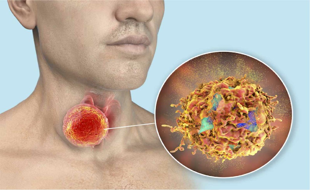 Neck Cancer Breast Cancer Surgery