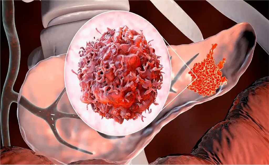 Pancreatic Cancer Complex Pancreatic Surgery