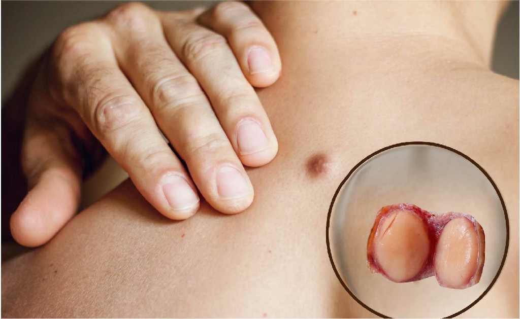Soft Tissue Cancer Laparoscopic Surgeon