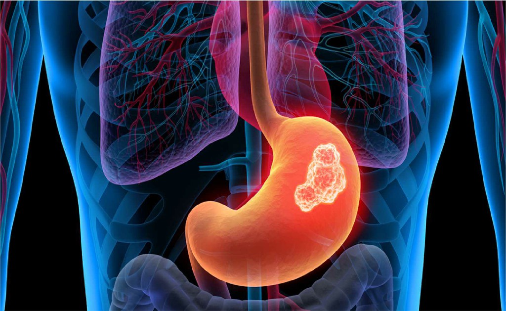 Stomach Cancer Laparoscopic Surgeon