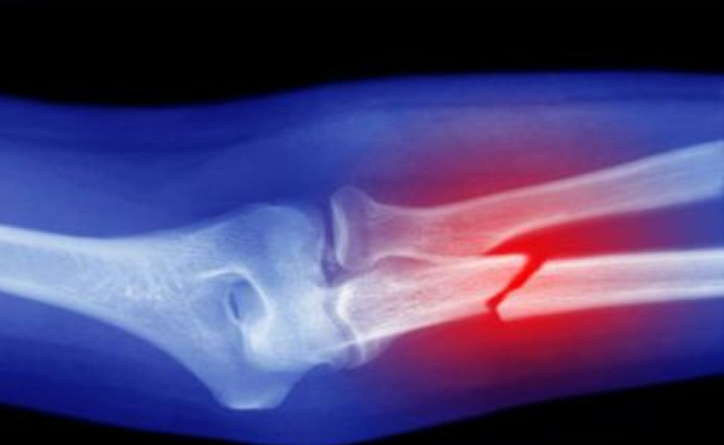 Both Bone Fracture Treatment Both Bone Fracture Treatment