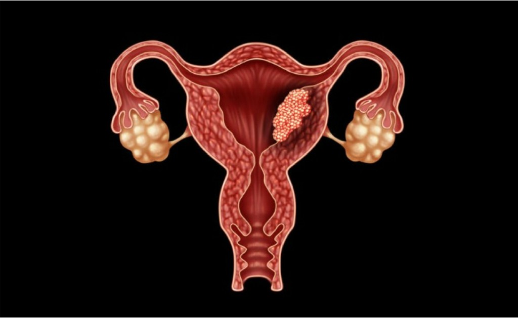 Fibroid Uterus Orthopedics