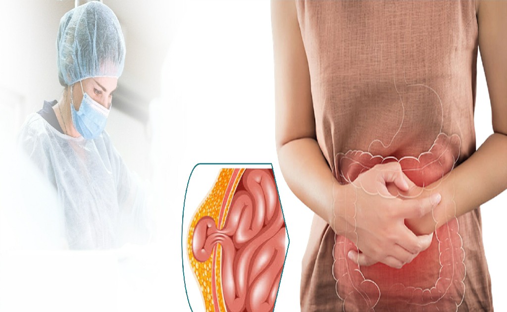 Hernia Open Surgery Hernia Open Surgery