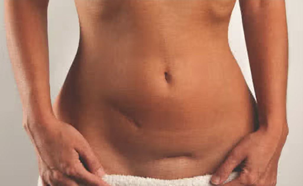 Hysterectomy Hysterectomy