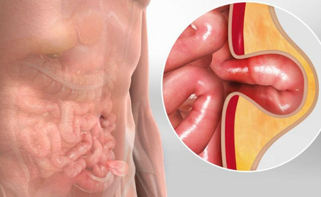 Inguinal Hernia Inguinal Hernia