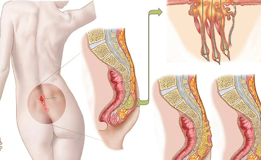 Pilonidal Sinus Pilonidal Sinus