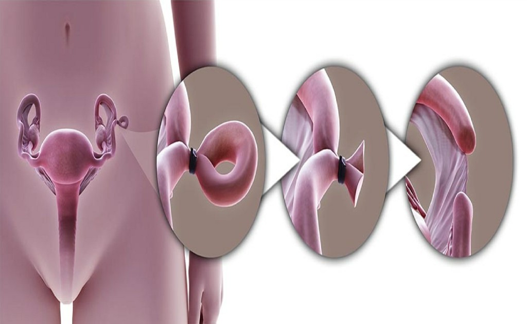 Tubal Surgeries Urinary Incontinence