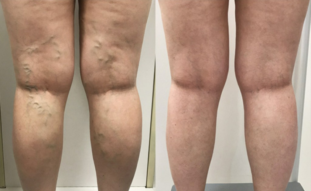 Varicose Veins Varicose Veins