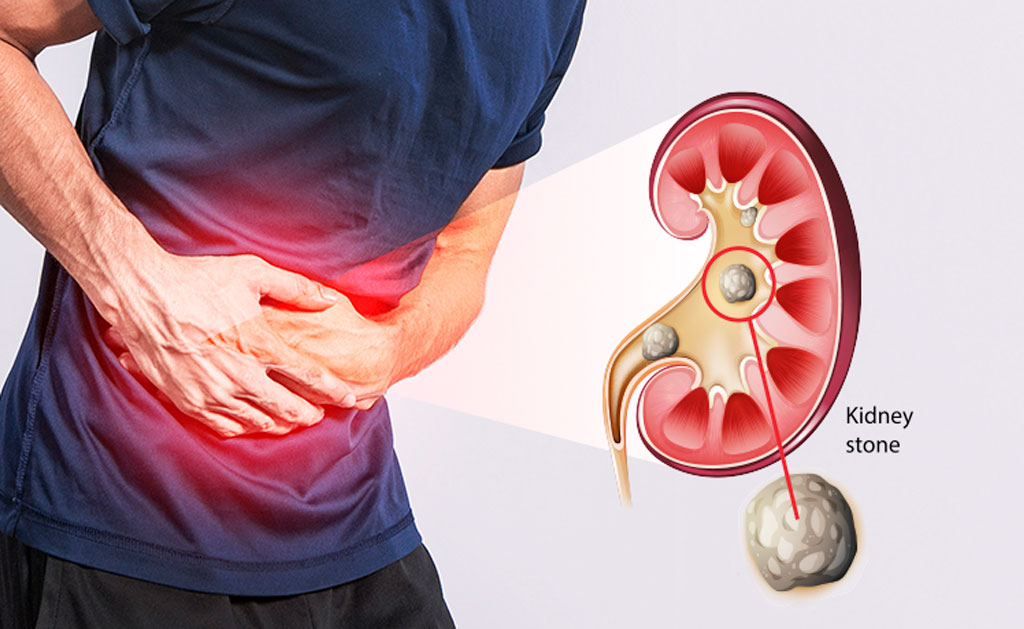 Kidney-stones Kidney stones