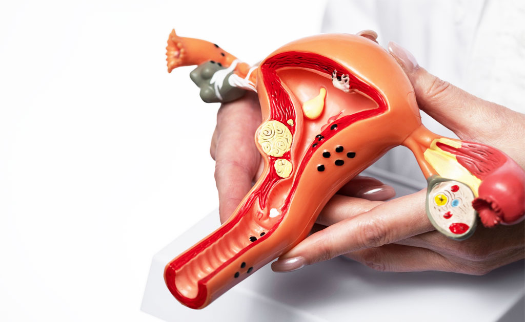 episiotomy Urinary tract infection