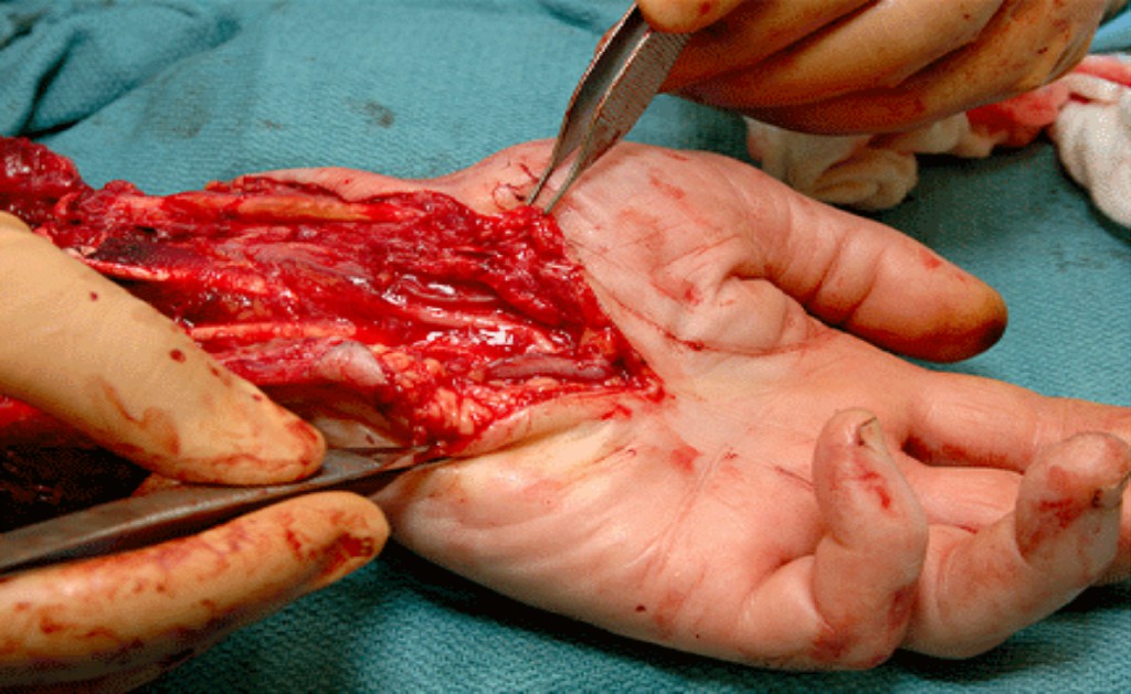 Hand Surgery