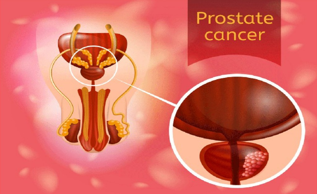 Prostate Cancer