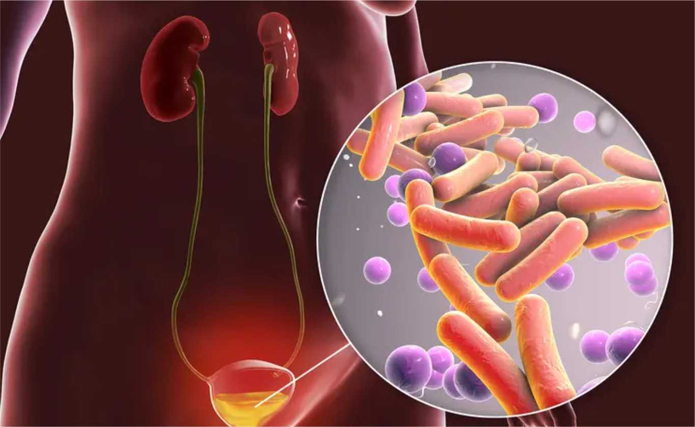 Bladder Treatment Urinary Incontinence
