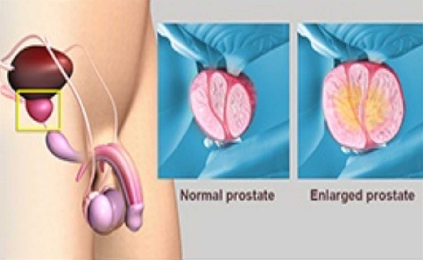 Enlarged prostate Kidney stones