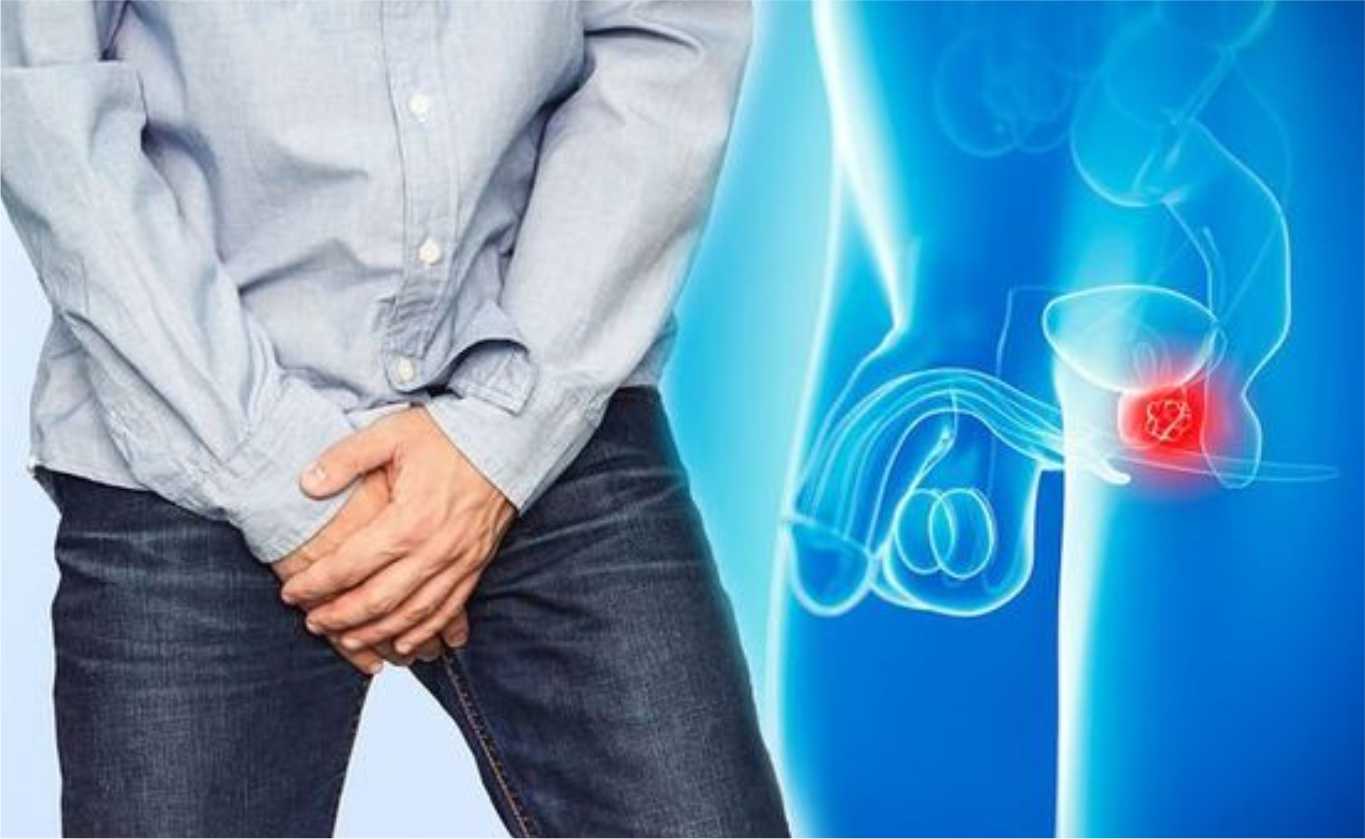 Prostate cancer Urinary tract infection