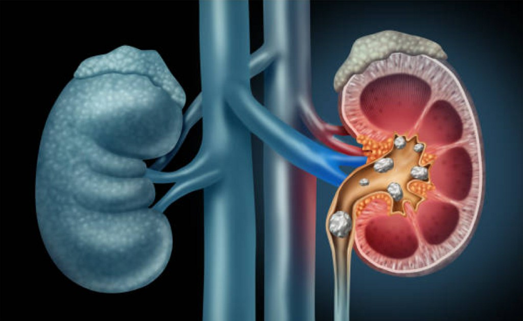 Kidney stones Kidney stones