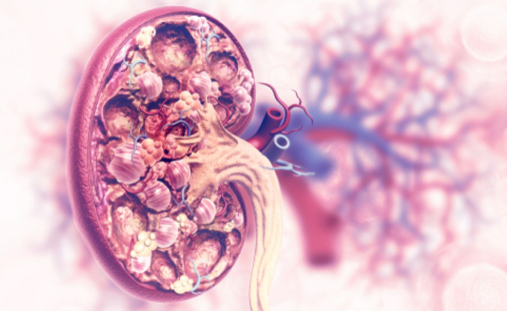 Lupus Nephritis Lupus Nephritis